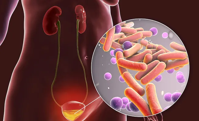 Many women face recurring urinary tract infections that affect daily life, intimacy, and overall well-being.